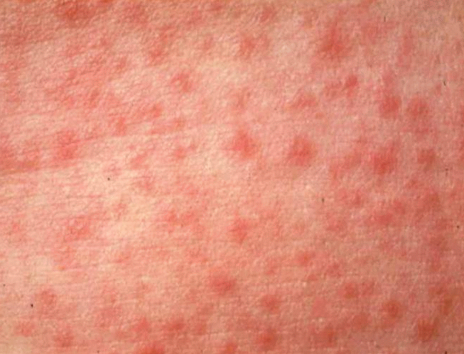 http://www.academ-clinic.ru/wp-content/uploads/2012/06/measles.gif