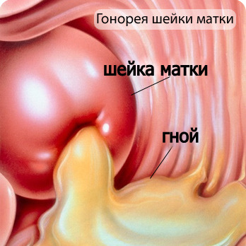 Гонорея у женщин Гонорея у женщин